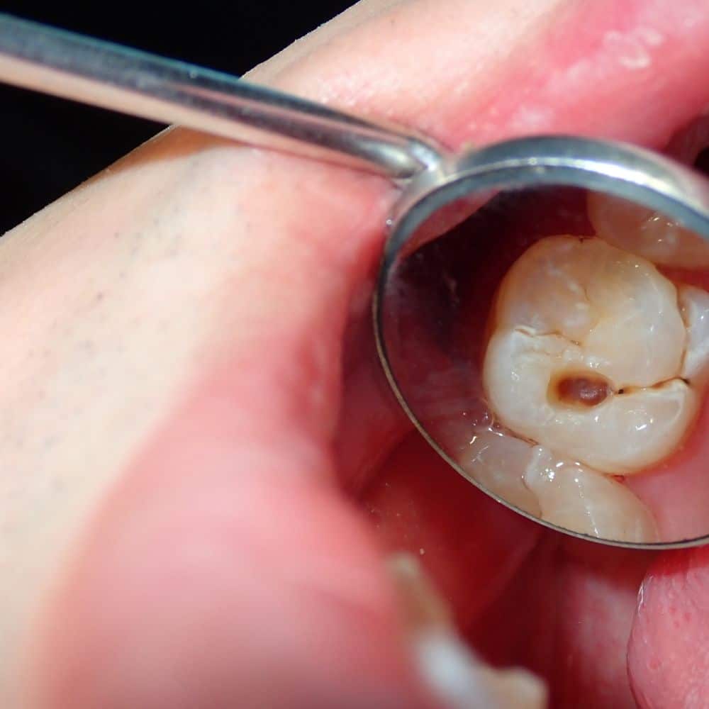How Long Can You Leave A Cavity Untreated